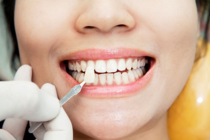 Estética dental en Zafra, Badajoz. Carillas en Zafra, Badajoz. Blanqueamiento dental en Zafra, Badajoz