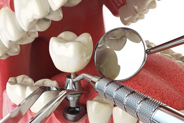 Implantes dentales en Zafra, Badajoz