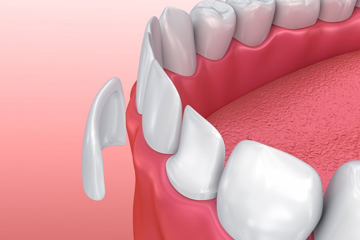 prótesis dentales en Zafra, Badajoz
