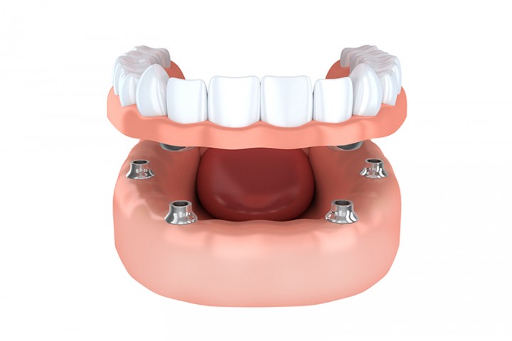 prótesis dentales en Zafra, Badajoz