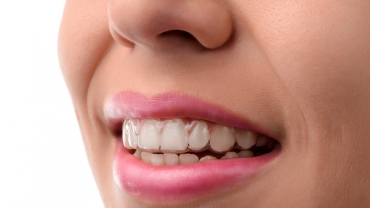 clincheck invisalign