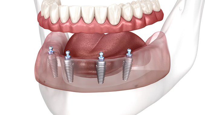 prótesis dentales