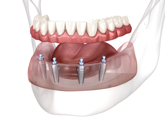 prótesis dentales
