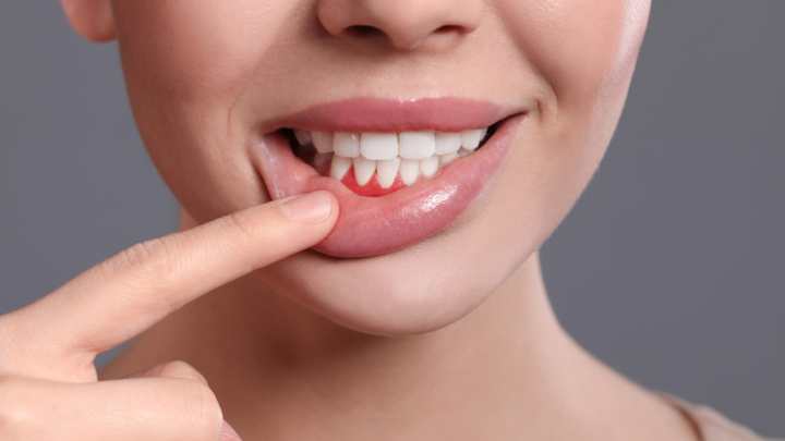 remedios caseros periodontitis