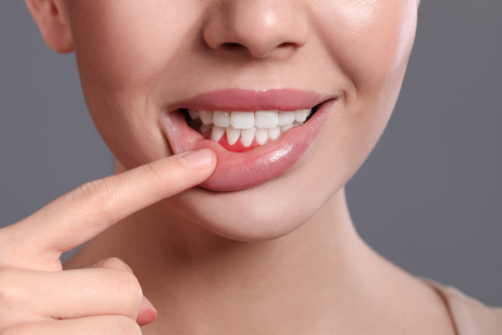 remedios caseros periodontitis